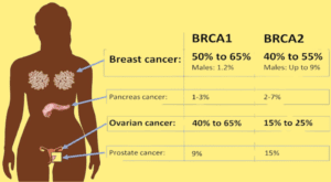 BRCA Gene Mutations and Breast Cancer